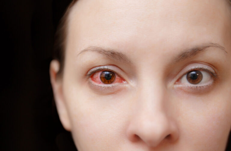 pink eye